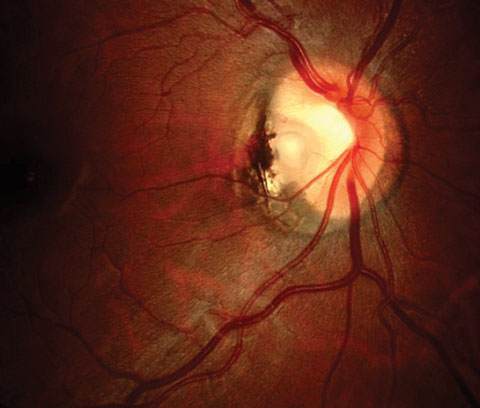 In this study, patients diagnosed with optic disc pit exhibited at a higher mean age and a greater prevalence of visual symptoms upon their initial presentation at the clinic, compared with patients diagnosed with optic disc coloboma.