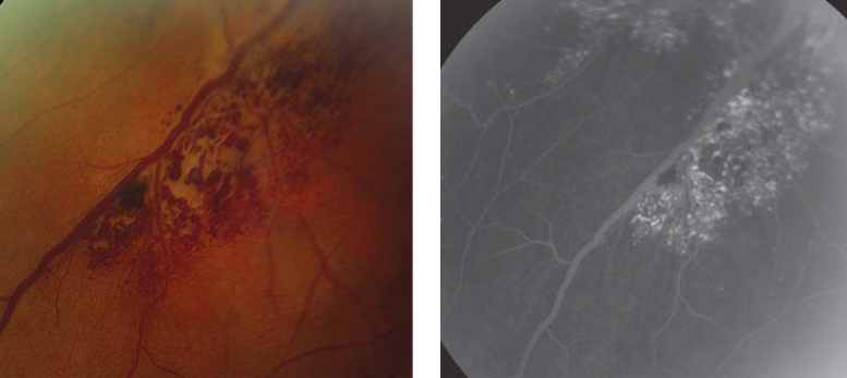 Retinal venous malformations like this cavernous hemangioma, if presenting concurrently with neuro-ophthalmic abnormalities, may warrant neuroimaging, study says.