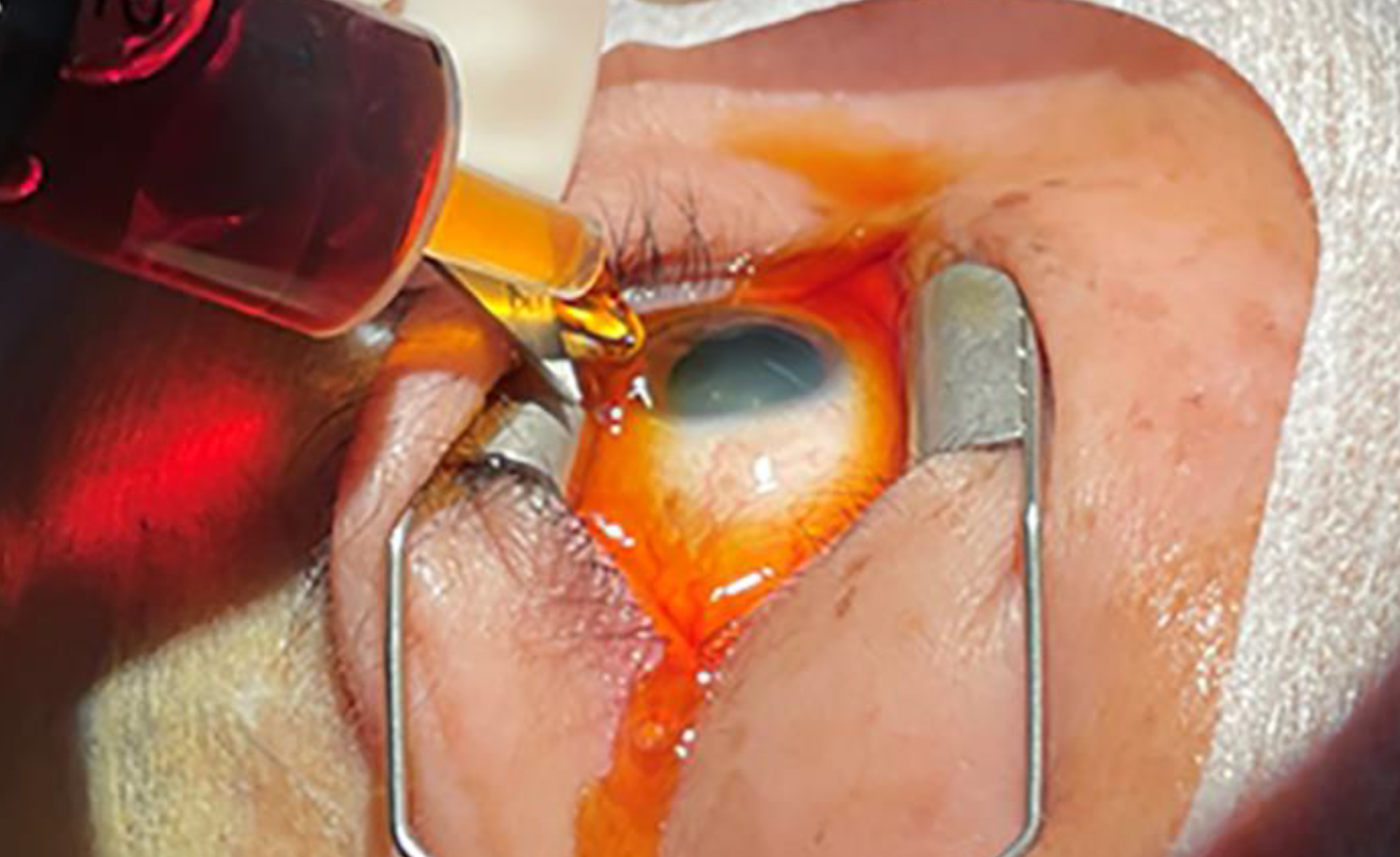 Beware of dry eye symptoms and other signs of ocular surface damage, such as goblet cell loss and impaired tear film stability, when managing patients who receive frequent intravitreal injections followed by a PVI agent.