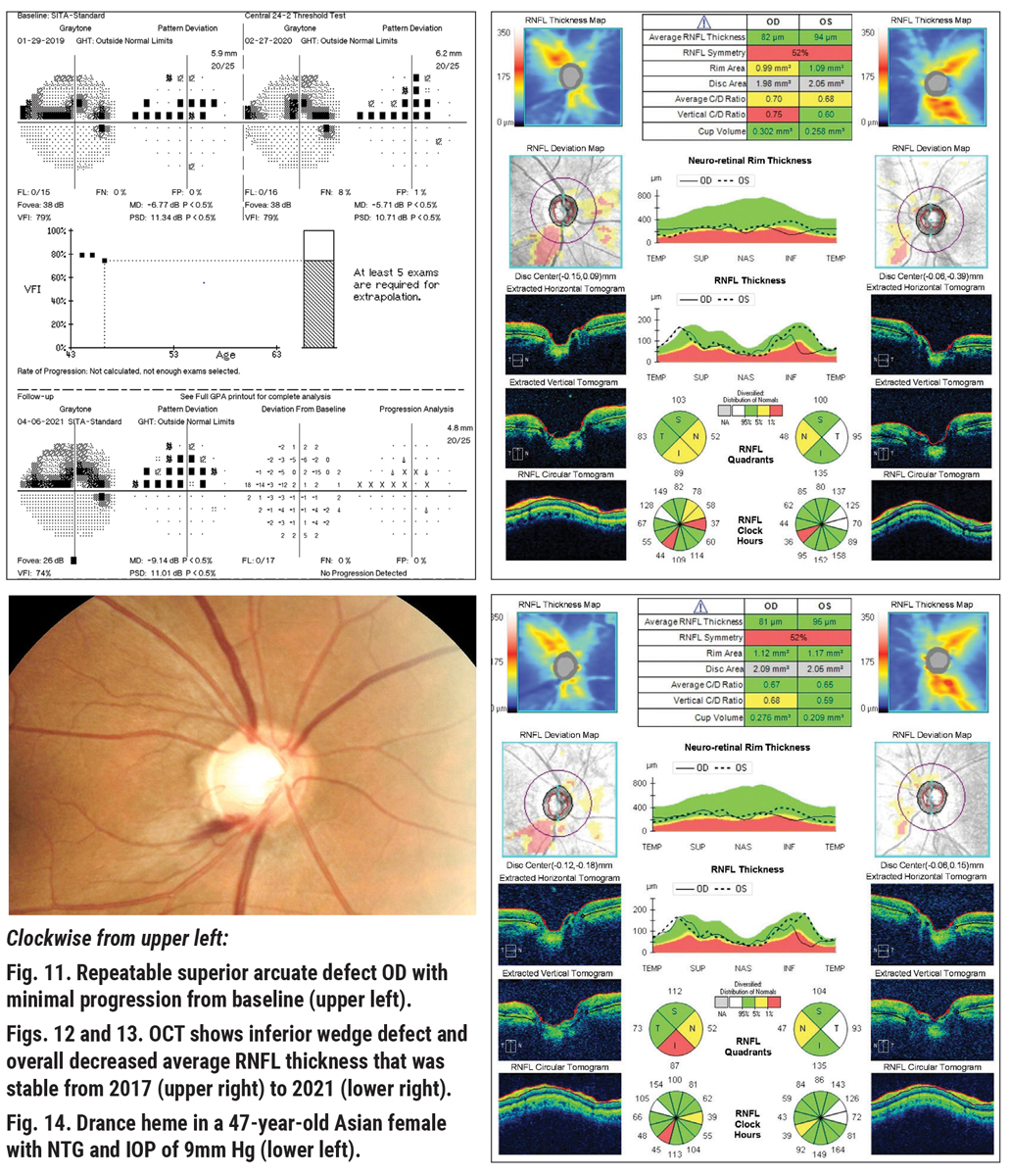 Disc hemorrhages often appears at or near glaucomatous disc/retina sites of change, RNFL defect border and site of peripapillary atrophy, suggesting its development is closely related to structural damage of the disc and/or retina. 