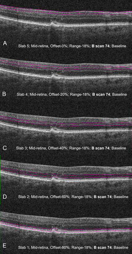 Structural OCT B-scan with corresponding slab locations showing the presence of intra-retinal hyperreflective foci. These lesions in the inner and outer retina may have disparate origins and pathophysiology, as evidenced by the inequal abundance in the outer retina.