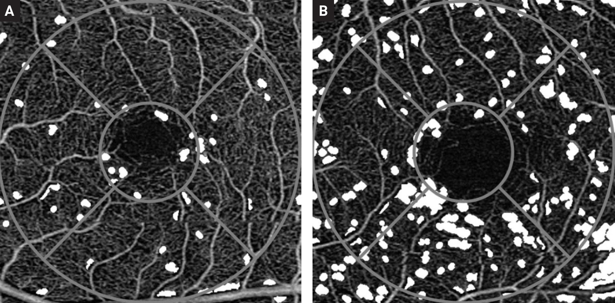 Nonperfused areas in the superficial capillary plexus are seen as white spaces in the intercapillary areas. Figure A is a 70-year-old subject without diabetes for comparison and figure B is the OCT-A scan of a 68-year-old diabetes patient without otherwise visible retinal lesions on fundus photography.