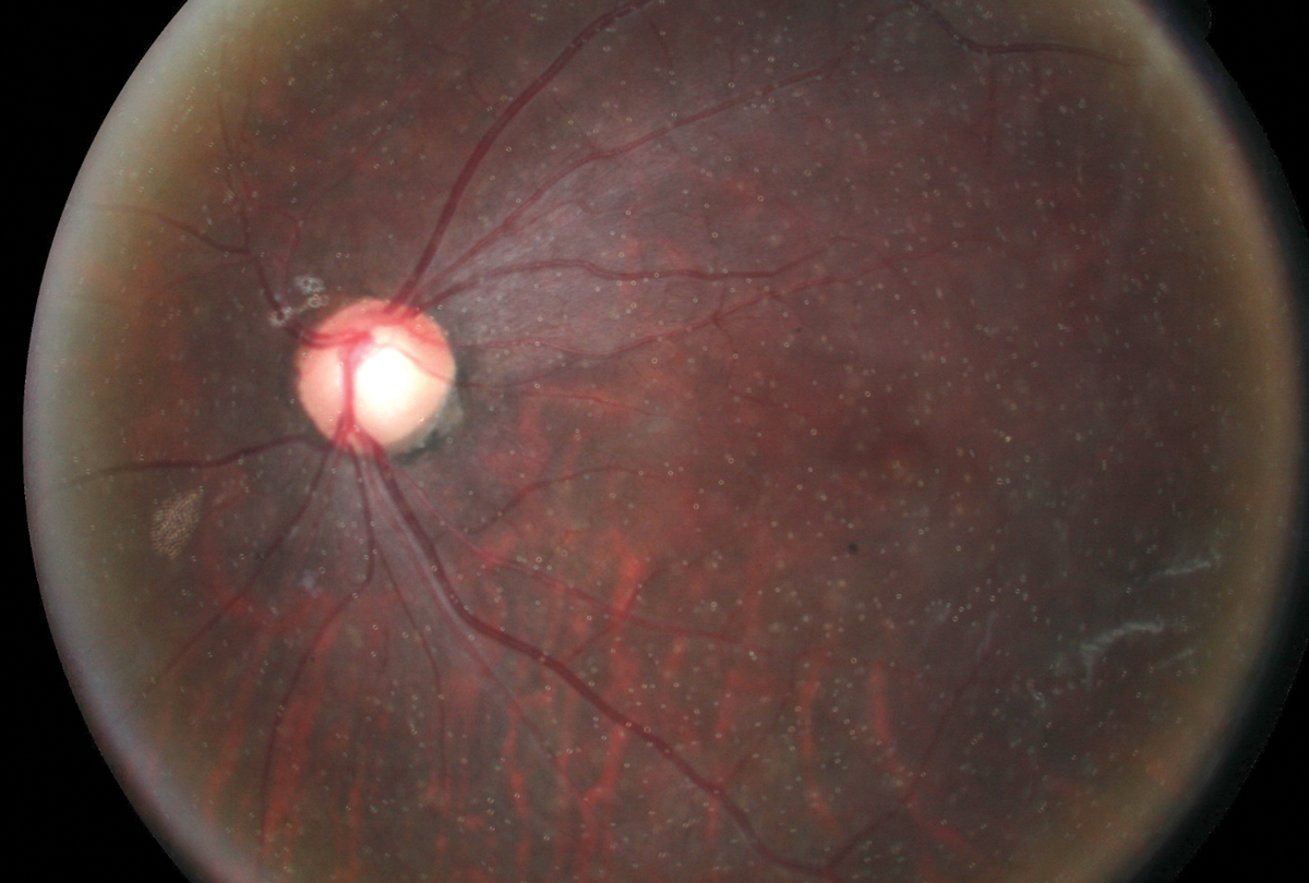 Silicone oil emulsification following pars plana vitrectomy for treatment of rhegmatogenous retinal detachment.