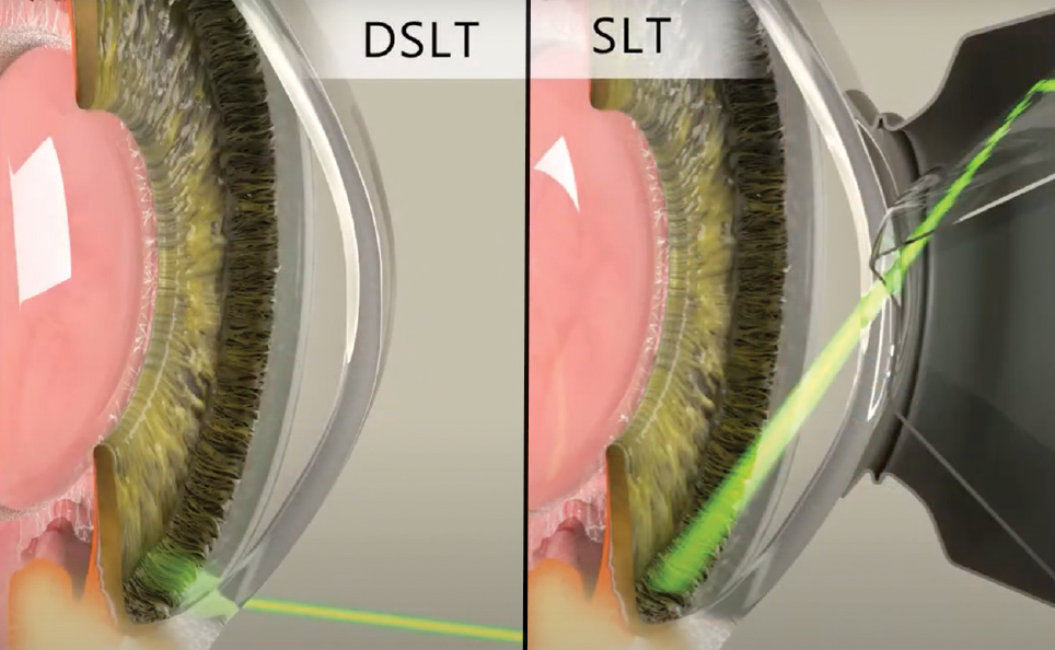 Fig. 4. DSLT obviates the need for a gonio lens by delivering laser energy directly through the limbal area.
