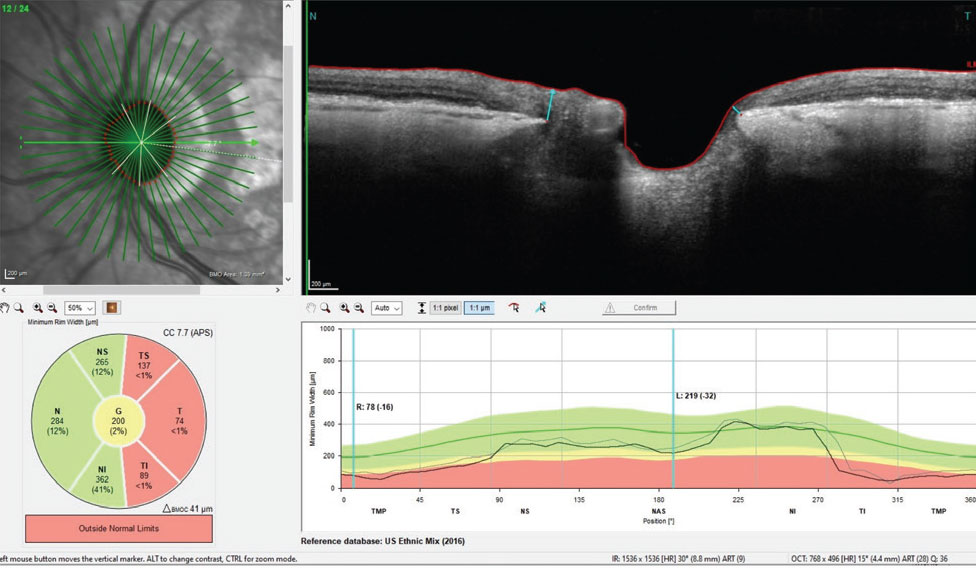 Fig. 2. BMO-MRW measurements of the left neuroretinal rim. Note, especially inferotemporally, the erosion of the neuroretinal rim, which accounts for her superior nasal step field defect in the same eye.