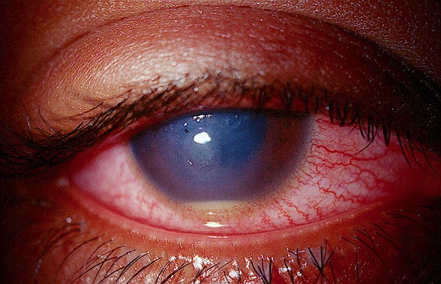 The risk of endophthalmitis changes over the course of treatment in eyes undergoing intravitreal injections, increasing at a higher rate earlier on in the treatment course then decreasing with more injections.