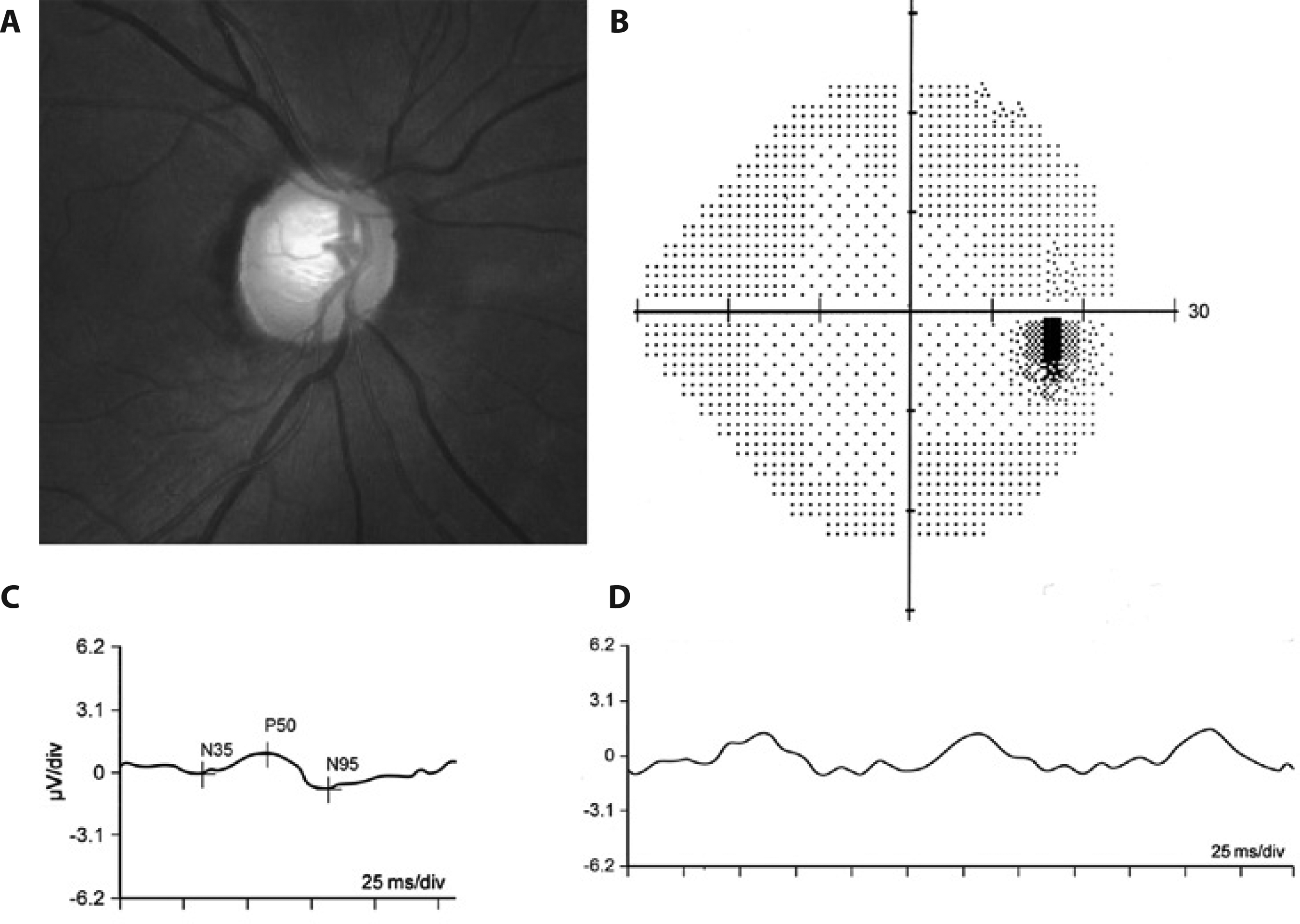 Representative example of an eye with pre-perimetric glaucoma and reduced pERG responses: (a) Fundus photo showing glaucomatous cupping; (b) normal 24-2 SITA Standard visual field result; (c) reduced transient pERG responses (P50 = 0.95μV; N95 = 1.65μV); (d) reduced steady-state PERG amplitude response (1.78μV).