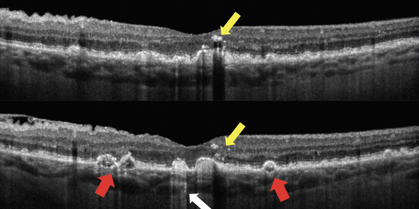 Given that intraretinal hyperreflective foci are a sign of distressed RPE, the researchers weren’t particularly surprised that complete retinal pigment epithelium and outer retinal atrophy frequently ensues in this location.