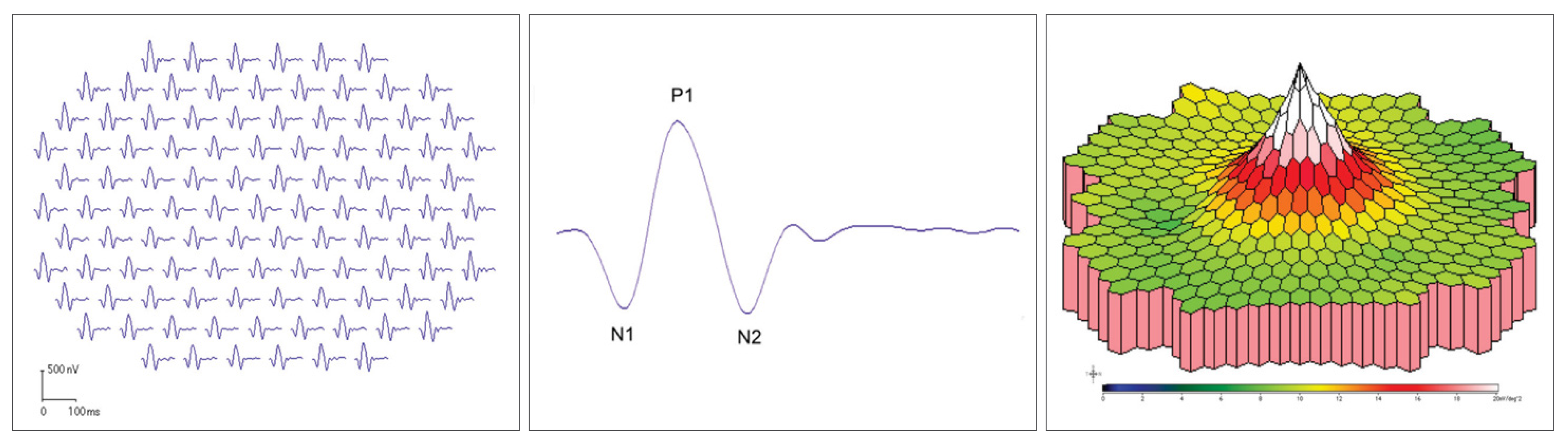 mfERG results are presented as a series of waveforms indicating electrical activity in the retina at each stimulus point (left image) as well as a topographic map of the results (right image). A typical wave is shown in the middle figure. 