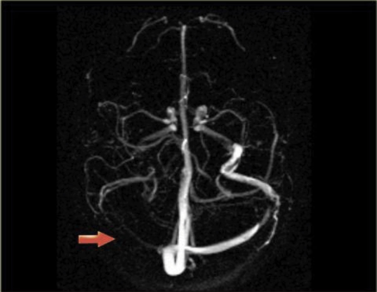 Fig. 3. Magnetic resonance venography showing that the right venous sinus has no signal due to thrombosis.