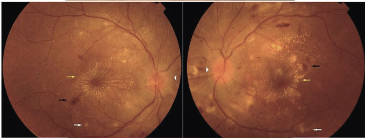 Fig. 6. Malignant hypertension with bilateral disc edema, macular stars, flame hemes and cotton wool spots.