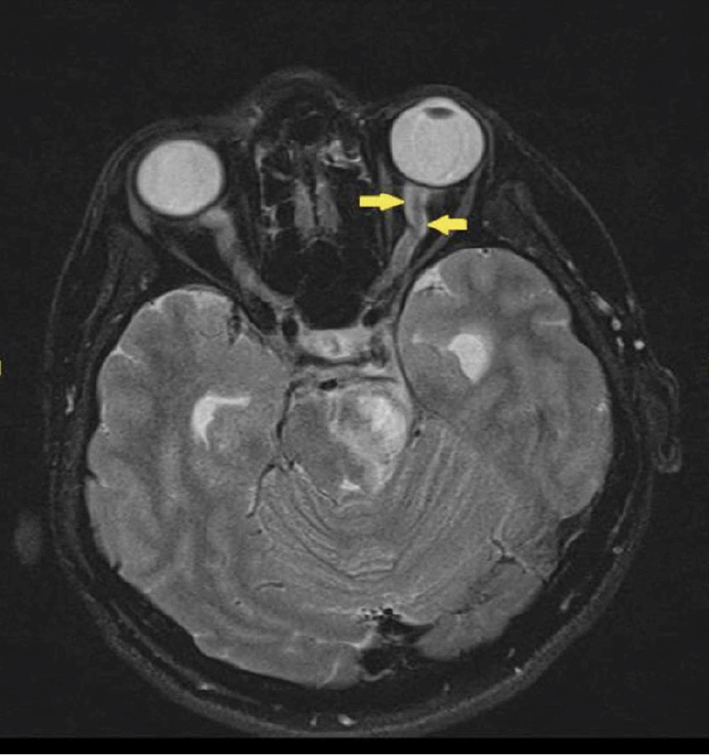 Fig. 7. Optic nerve sheath enhanced in a case of optic perineuritis, also known as the “tram-track” sign. This sign is not specific to optic perineuritis and can also be seen in optic nerve sheath meningiomas.