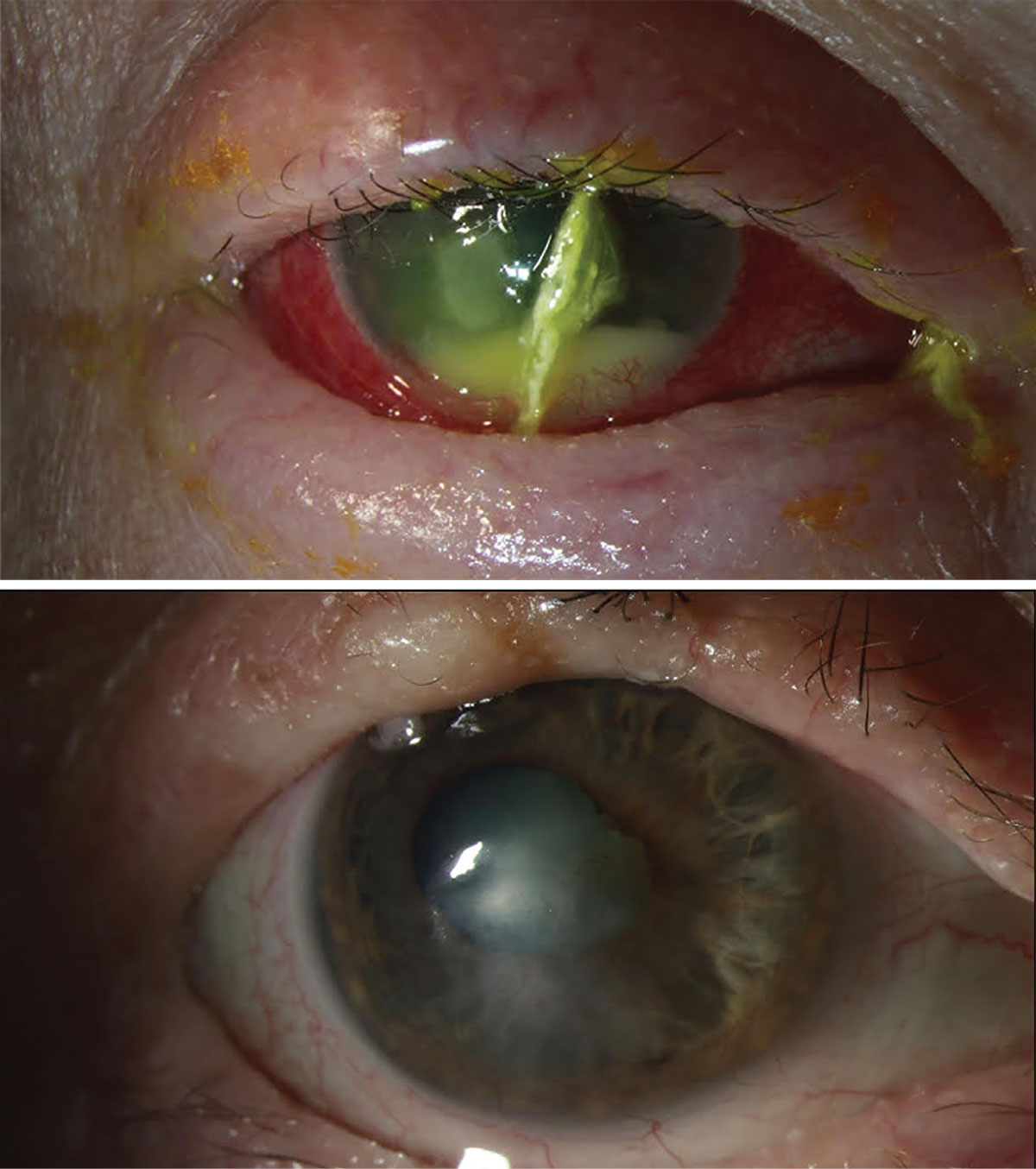 Slit-lamp photograph of a patient with bilateral Curvularia keratitis (top), who was successfully treated with medical therapy and RB-PDAT (bottom).