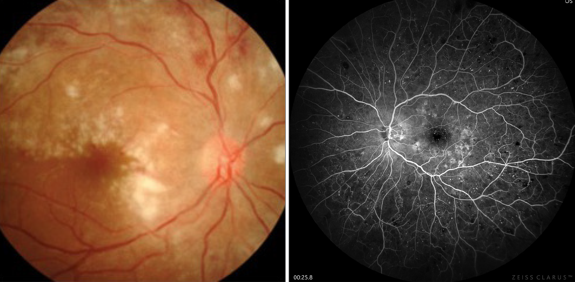 Intermediate uveitis has been linked to an earlier onset of posterior vitreous detachment, which prevents the further progression of DR into proliferative stages.