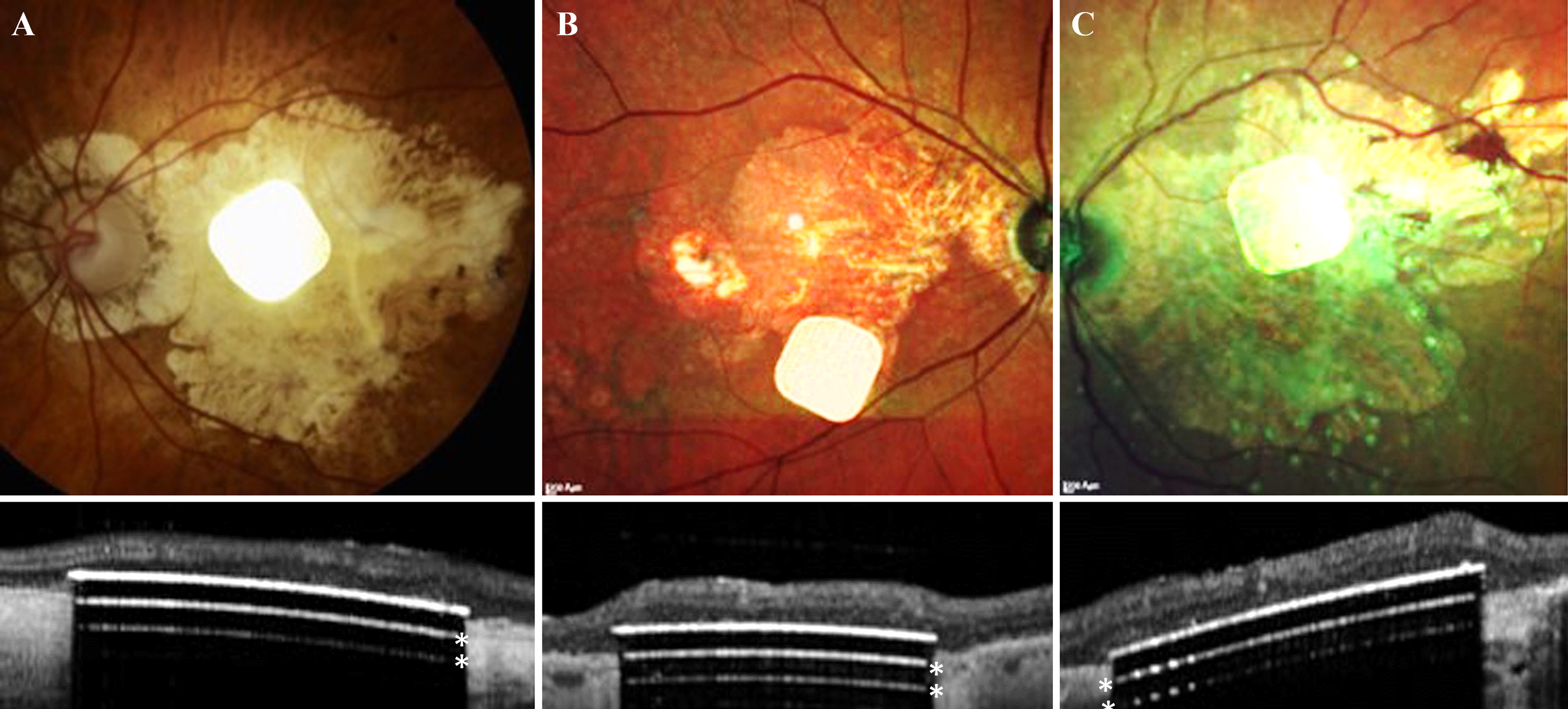 Subretinal implantation of Prima in subjects with GA suffering from profound vision loss due to AMD is feasible and well tolerated, according to this study. These photos and OCT scans show placement in the three successful subjects. (The two white lines below the implant surface (*) are OCT artifacts due to strong light reflection from the implant surface.)