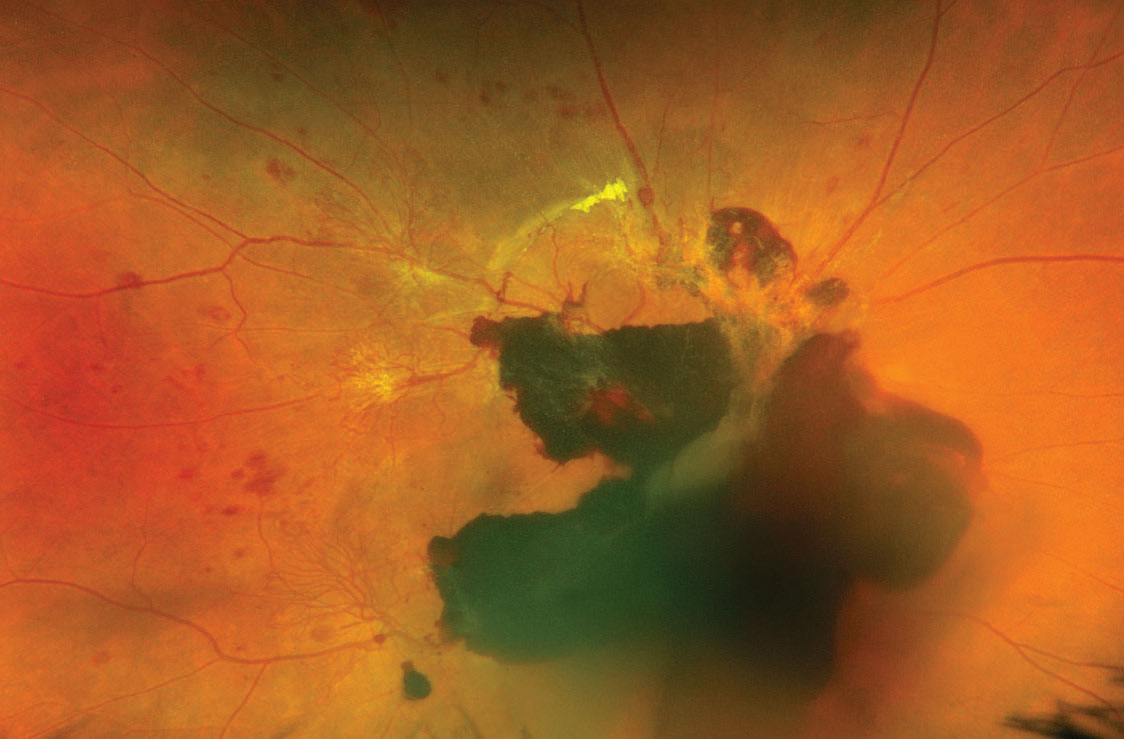 Researchers reported that vitreous hemorrhage was the most prevalent in uninsured PDR patients (35.1%) and the lowest in Medicaid patients (14.2%). 