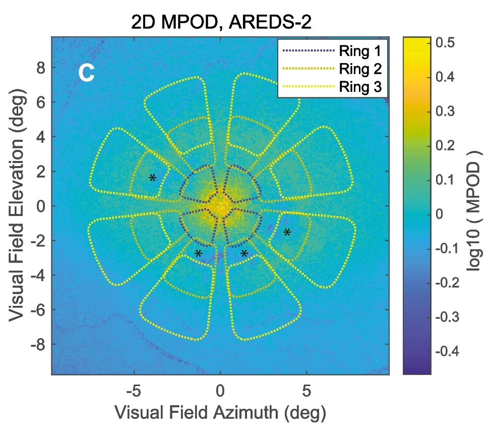 Several MPOD measures produced good diagnostic power for discriminating earlier from later-stage AMD. This image from the study overlays the objective perimetry stimuli pattern (the dartboard-style layout) over a map of macular pigment optical density.