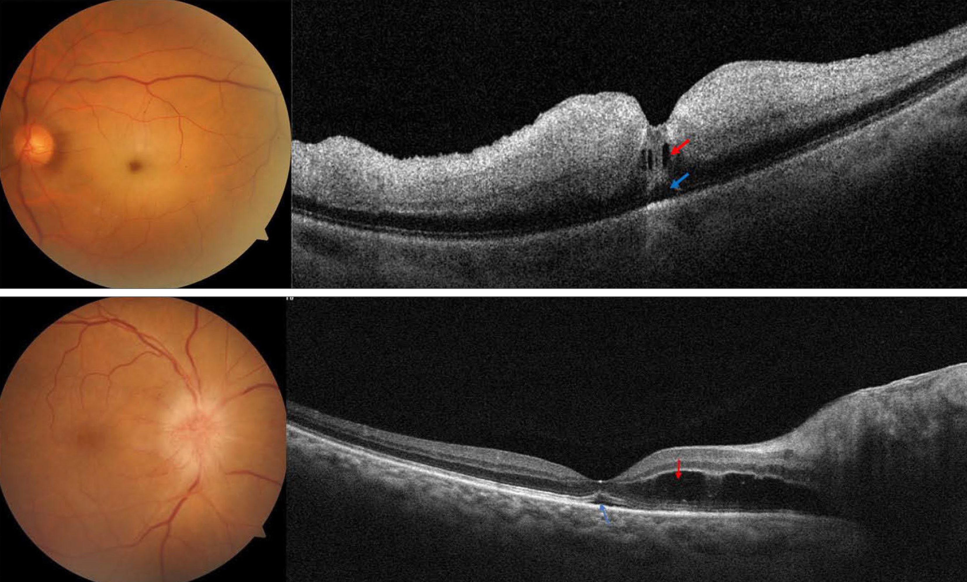 Representative cases of macular fluid in acute central retinal artery occlusion (top) and acute non-arteritic anterior ischemic optic neuropathy, from the study. Evidence of intraretinal fluid (red arrow) and subretinal fluid (blue arrow) is noted in each case.