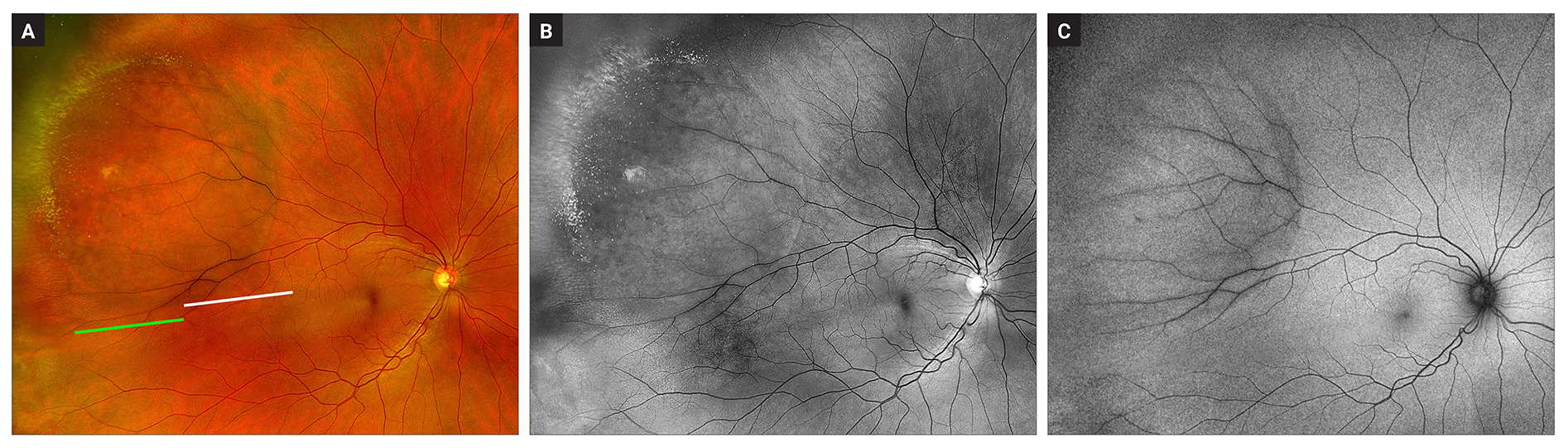 These images from the study show superotemporal degenerative retinoschisis in the right eye: (a) Pseudocolor image shows smooth, dome-shaped retinal elevation with well-defined and darker vasculature. Reticular pattern is visible in the anterior half of the area of retinoschisis and there are hyperreflective foci present at the anterior border of the area of retinoschisis. (b) Green-separated image showing reticular pattern and hyperreflective foci corresponding to the distribution on the pseudocolor image. (c) Autofluorescence imaging showing a hypoautofluorescent posterior border and isoautofluorescence over the area of schisis.