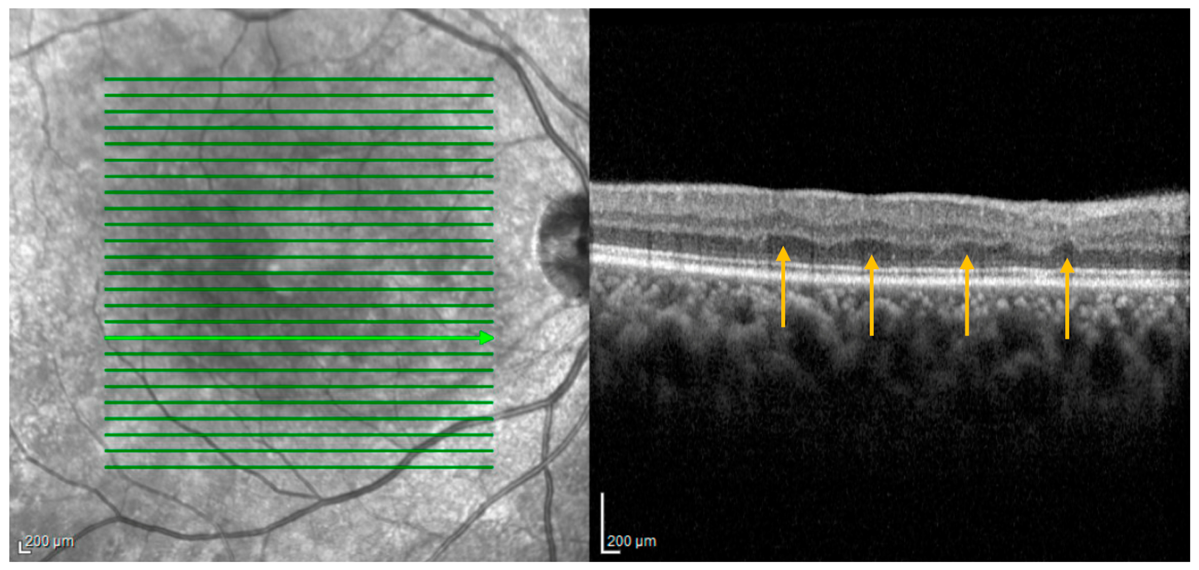 RIPLs are thought to arise at the sites of previous middle retinal layer infarcts, potentially evolving as a subsequent manifestation of paracentral middle maculopathy, wherein the hyperreflective inner nuclear band observed during the acute phase gradually undergoes atrophy over time.