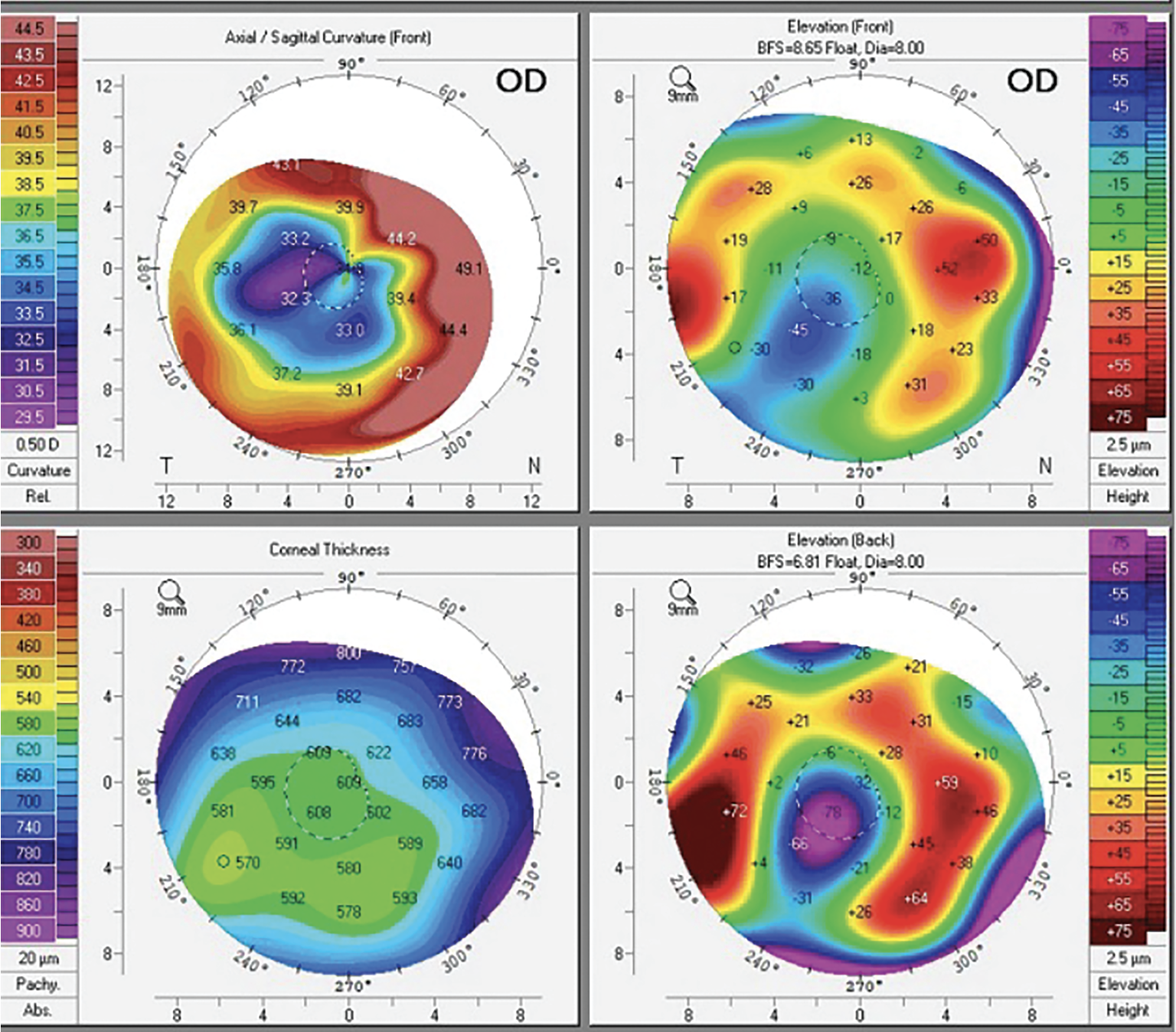 Corneal topography of a patient with RK. 