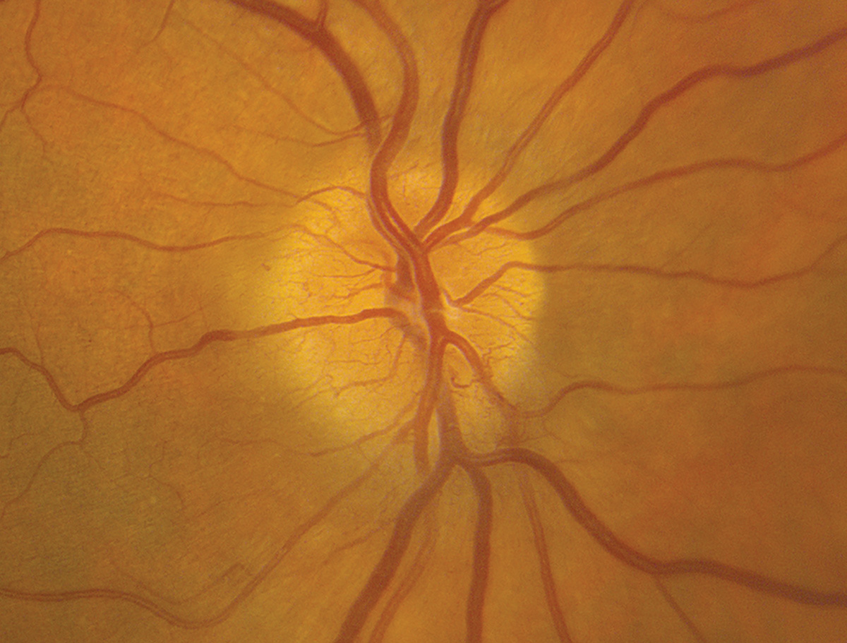 Hyperemia was the most common fundus feature identified in acute NAION patients in this study. While no single fundus feature correlated to VF loss, combining multiple features resulted in an accuracy of 73.6% in classifying the level of VF loss. 