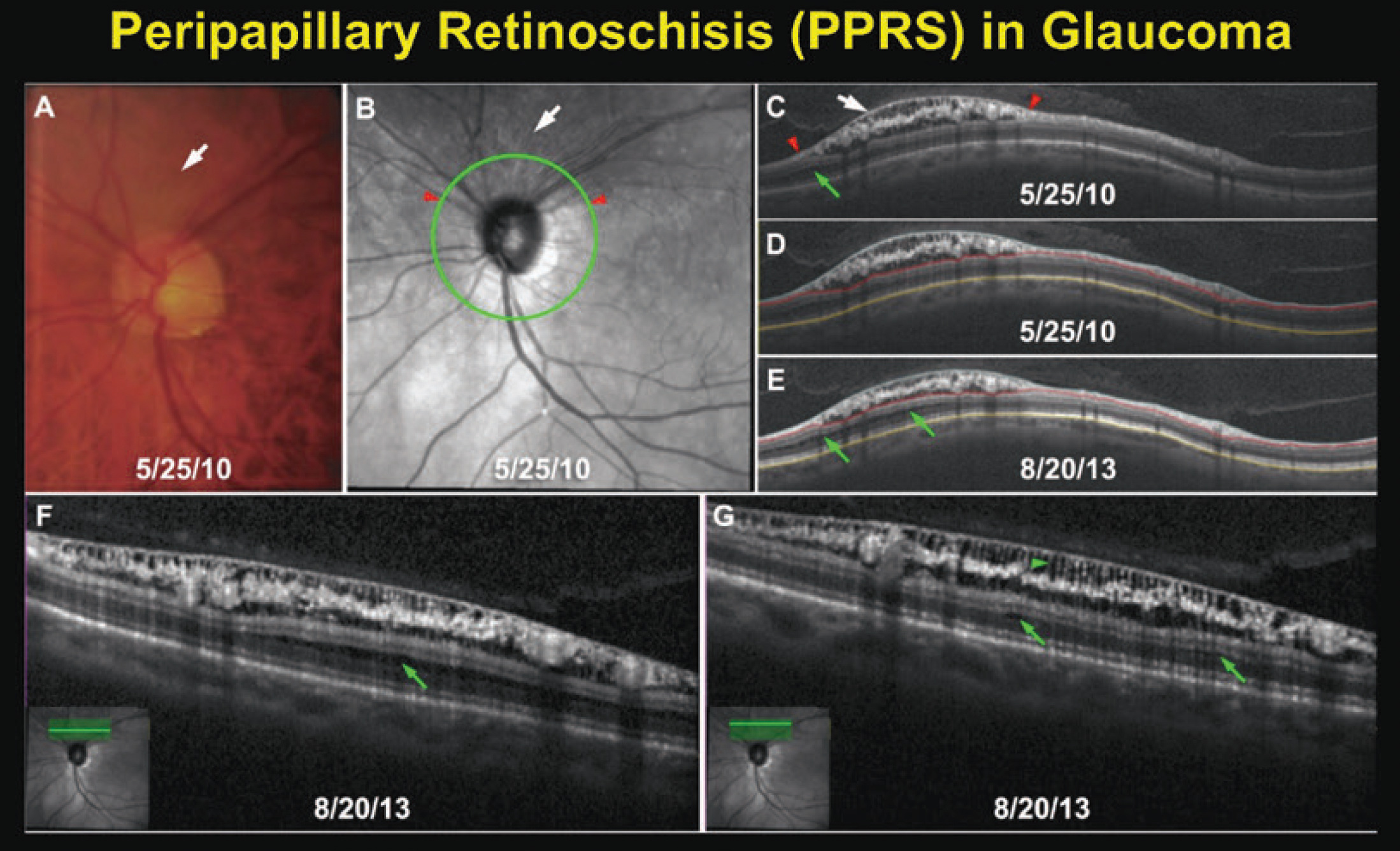 Optometrists should exercise caution when interpreting OCT data for glaucoma patients in the presence of peripapillary retinoschisis, study warns.