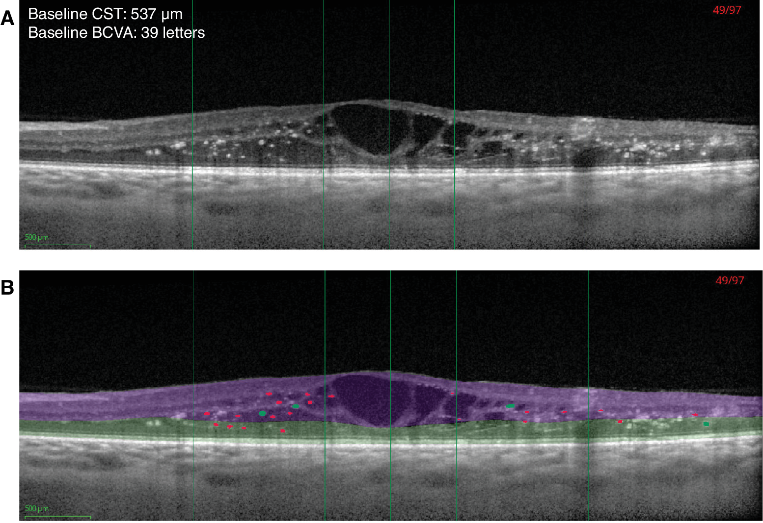 This image from the study shows automated hyperreflective foci (HRF) segmentation on SD-OCT without (A) and with (B) segmentation of layers. HRF ≤50µm are shown in red and larger (>50µm and ≤100µm) intraretinal hyperreflective objects in green. The algorithm filtered out objects >100µm; hence, these objects are not colored in the figure. ETDRS rings are indicated with green vertical lines (center, 1mm and 3mm diameter rings). Inner retina is shown in purple and outer retina in green. 