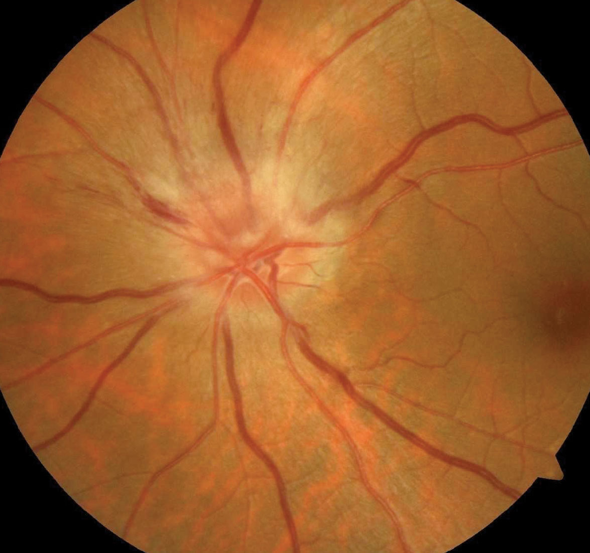 Nine out of 10 neuro-ophthalmologists responding to this survey recommended against treatment for NAION in most cases, though high-dose steroids were favored in some scenarios.
