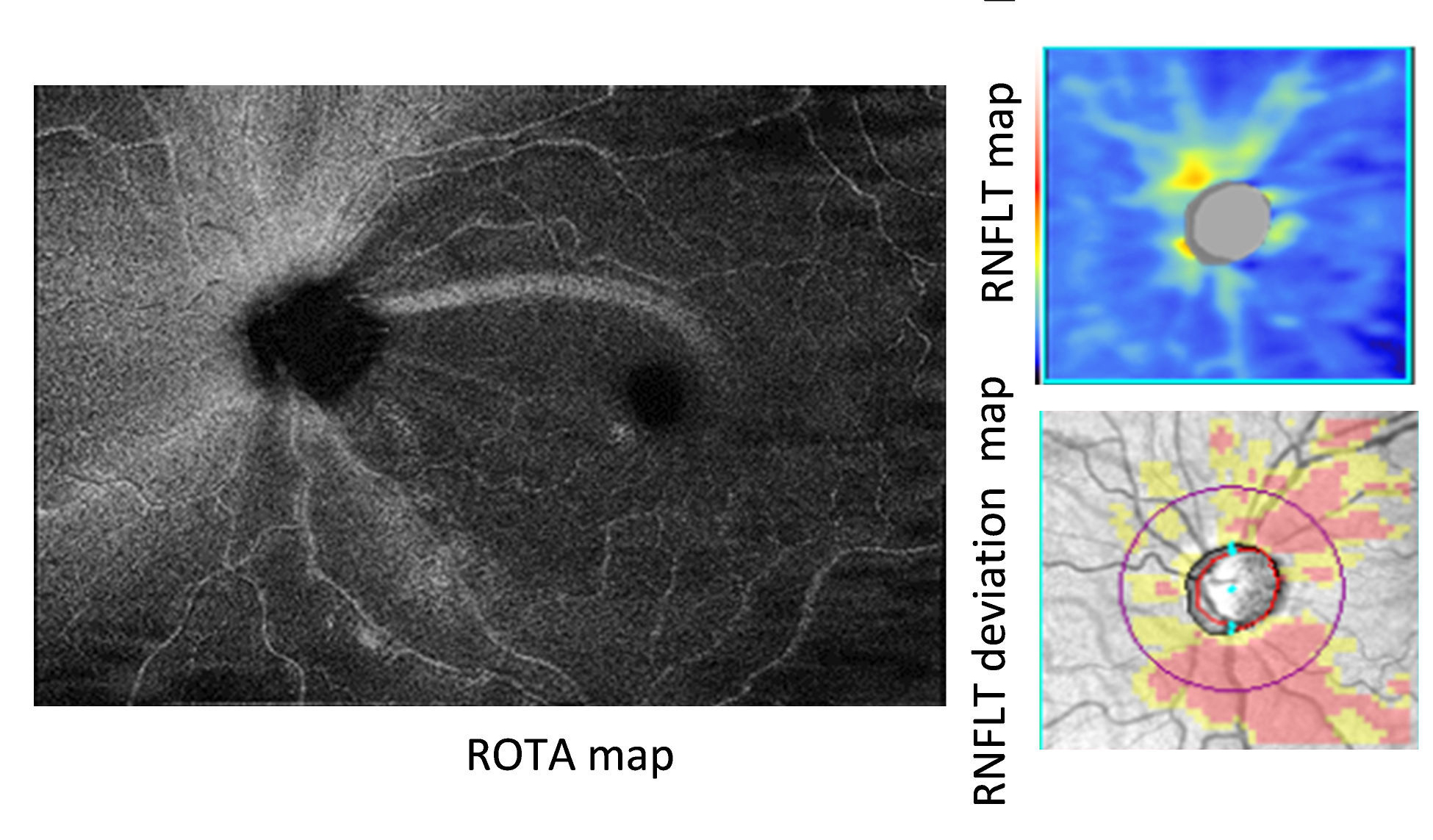 Papillomacular and papillofoveal RNFL bundle defects were a common finding in eyes with glaucoma in this study with prevalence rates of 92.1% and 37.9%, respectively.