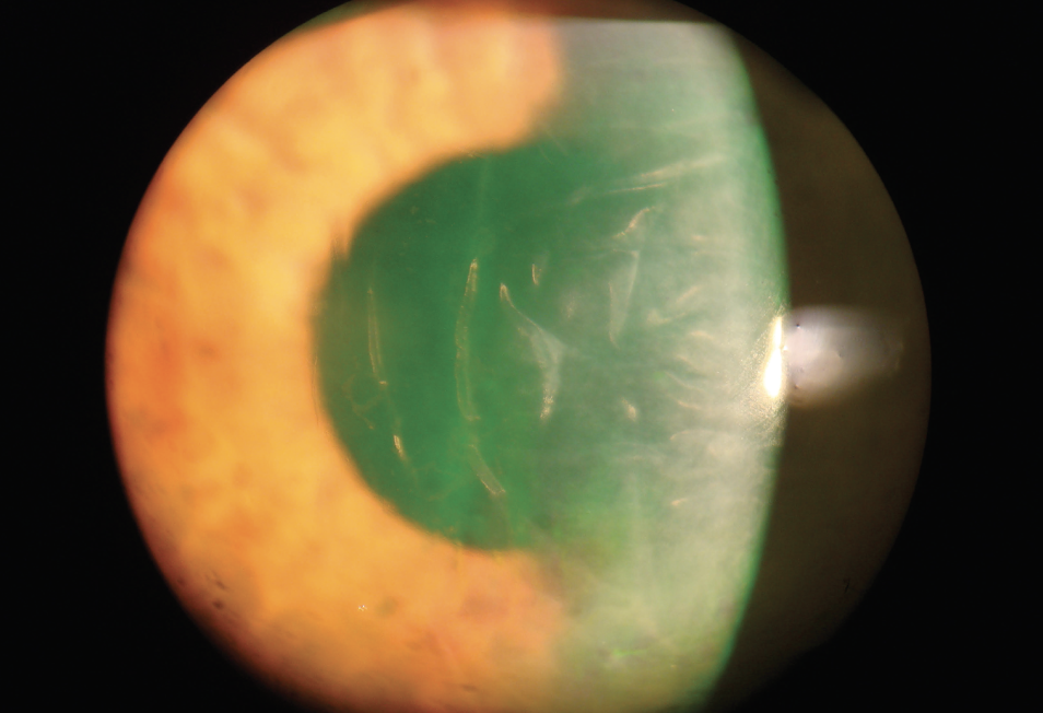 Racial and ethnic minorities were found to be the highest risk of corneal edema, but further research is needed to understand these underlying factors.