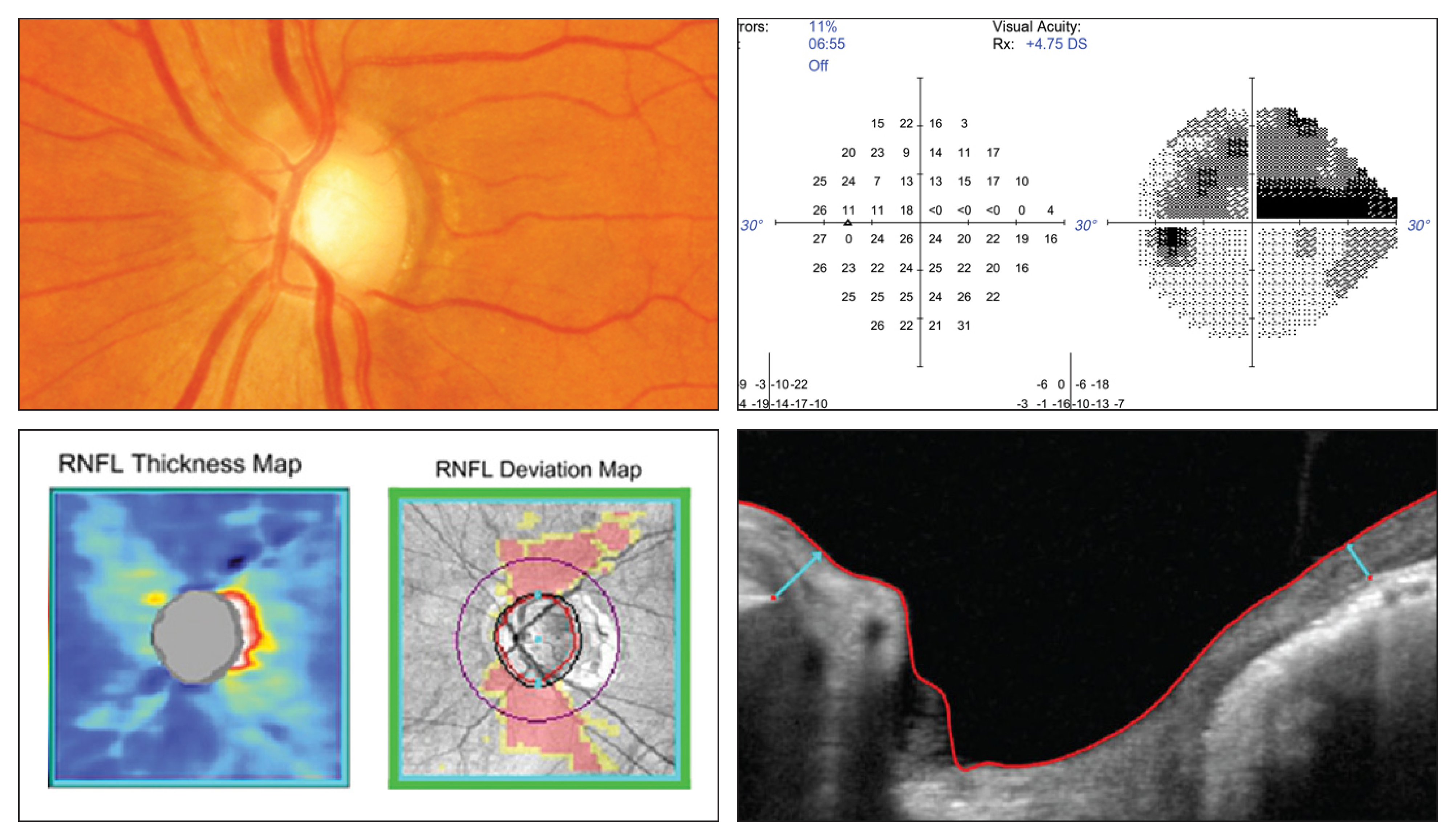 Over a five-year period, it was rare for all four tests of structure and function—optic nerve head assessment, visual fields, RNFL thickness and BMO minimum rim width—to progress, (only 6.5% of eyes). Instead, progression is usually detected by just one or two tests (41.1% by only one test; 21.8% by two tests, respectively).