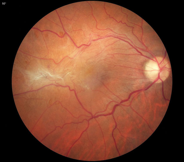 Vitreomacular interface abnormalities were once thought to act as barriers to anti-VEGF diffusion, but because early CMT response to treatment is seen in patients with these abnormalities, researchers now say it’s more likely that any observed differences are due to changes in the behavior of these eyes after six months.