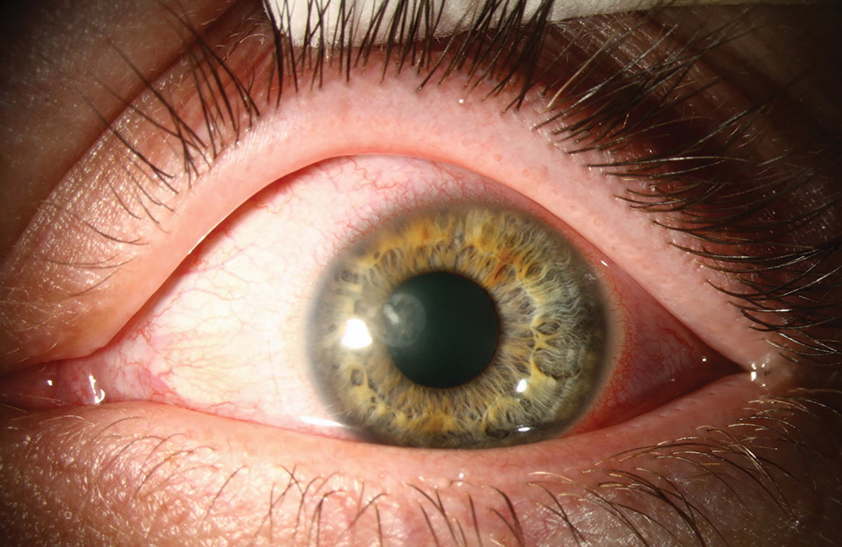 A corneal infiltrate (in a different patient) resembling an abrasion in a mildly hyperemic left eye confirmed later to be fungal keratitis.