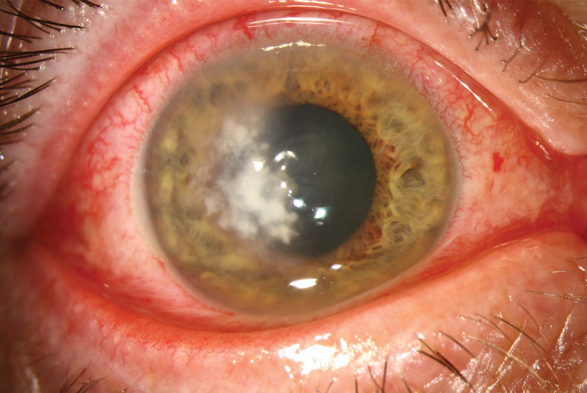 A corneal infiltrate with feathery edges in a red eye of a different patient proven to be due to a fungal infection.