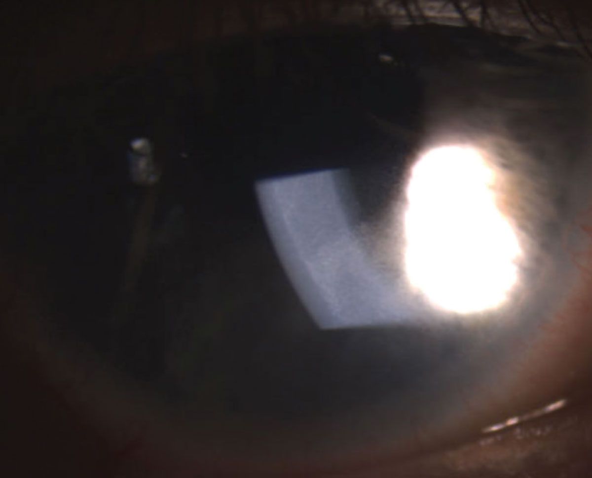 Uveitis, pictured here, is one ocular condition with marked inflammation, which would be indicated upon ESR or CRP testing.