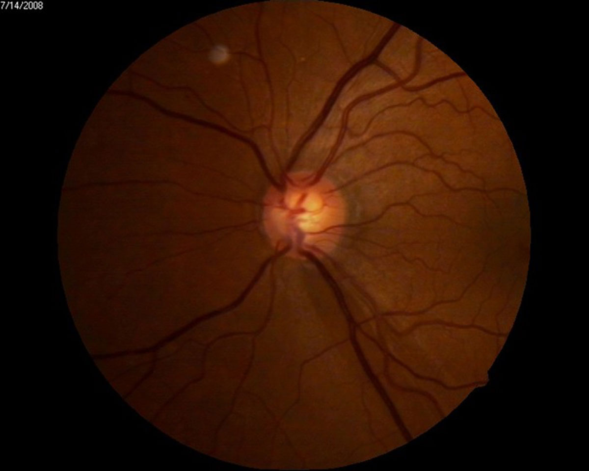 Fig. 2. Optic nerve head photo OS of a 59-year-old Black female with a notch noted along the inferior temporal neuroretinal rim with an associated nerve fiber layer wedge defect.