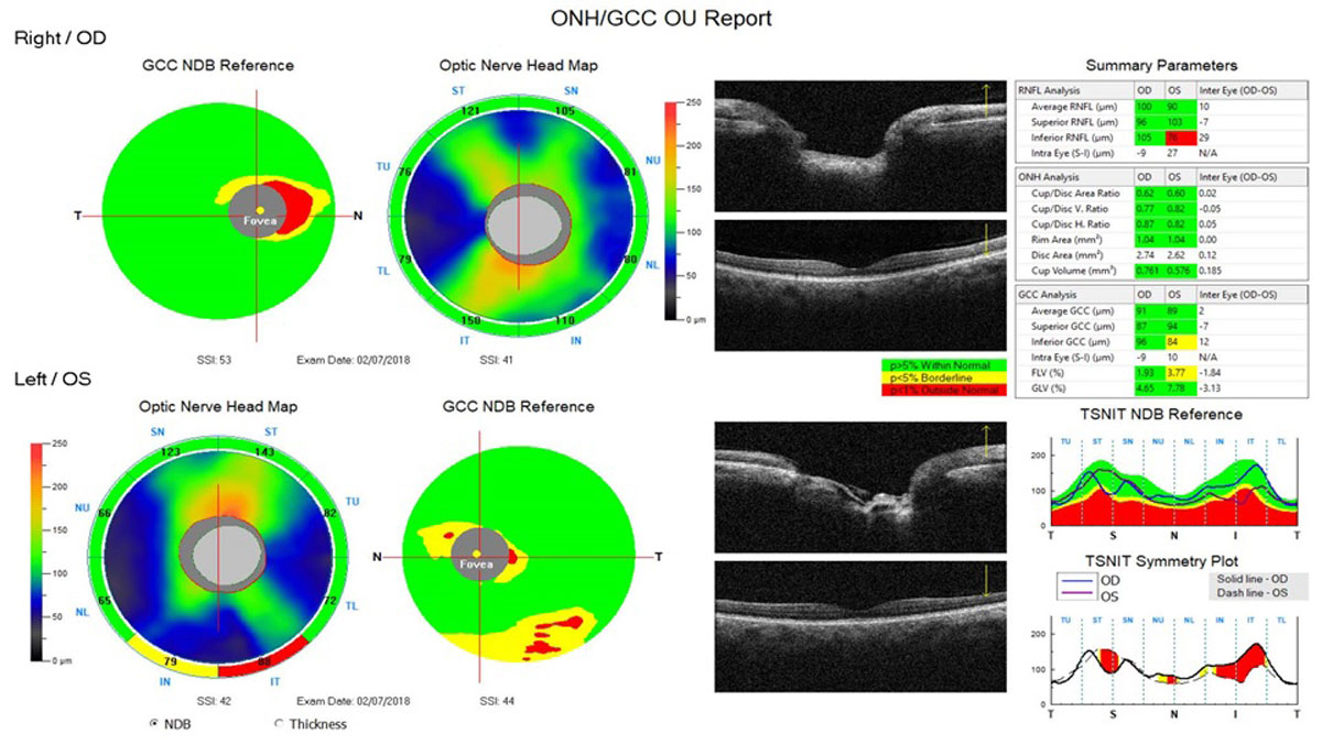 Fig. 3. This ONH/ganglion cell complex (GCC) analysis of the patient in Figure 2 demonstrates peripapillary nerve fiber layer and GCC defects correlating to the glaucomatous notch noted on the optic nerve.