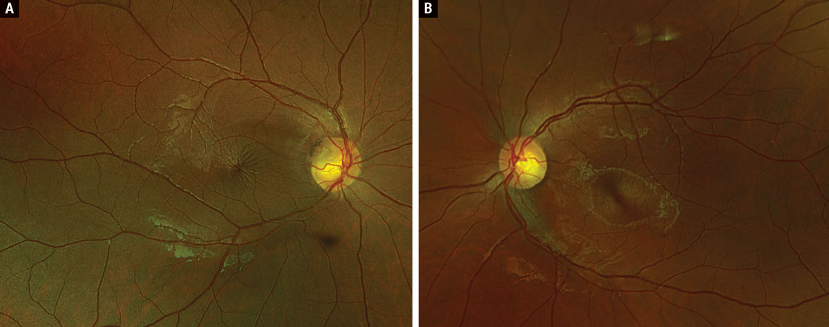 Fig. 1. Optos widefield fundus photography of the right (A) and left (B) eyes.