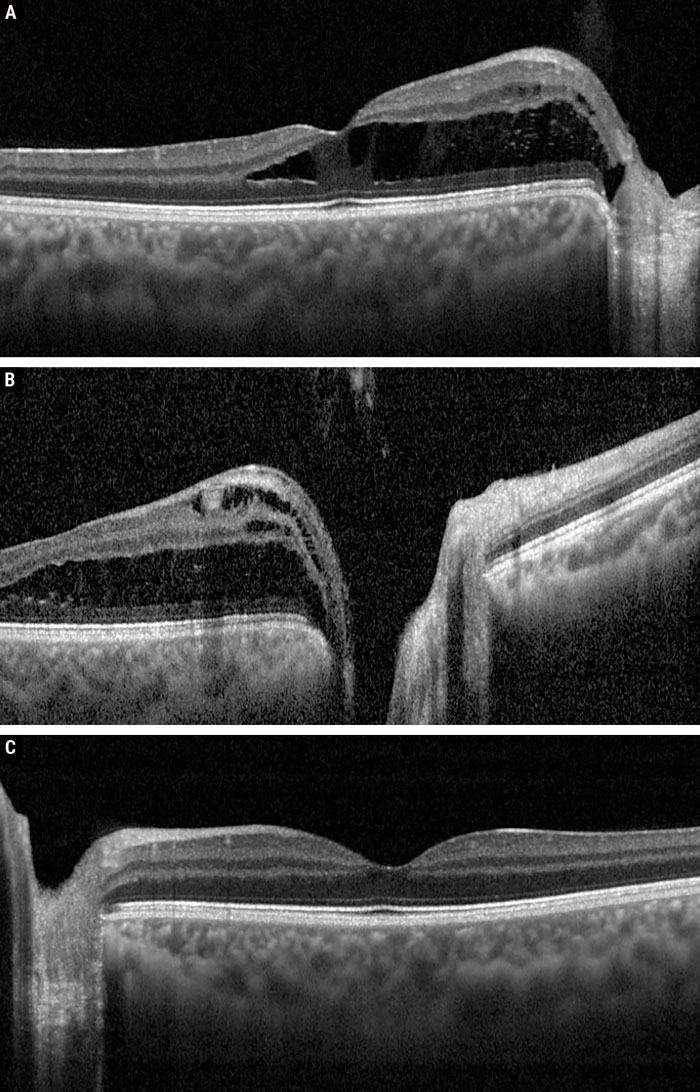 Fig. 2. OCT raster through the OD fovea (A), OD optic nerve (B) and OS fovea (C).