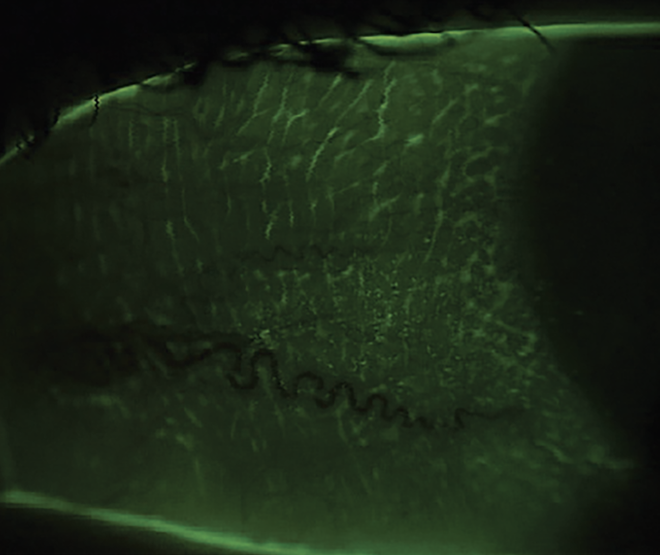 Fig. 1b. Trace conjunctival staining with NaFl and a Wratten filter, the latter of which helps to detect subtle conjunctival staining without using other irritating dyes. Conjunctival staining indicates damage to the mucin-producing goblet cells. A nighttime ointment with vitamin A is a useful treatment for this type of staining. 