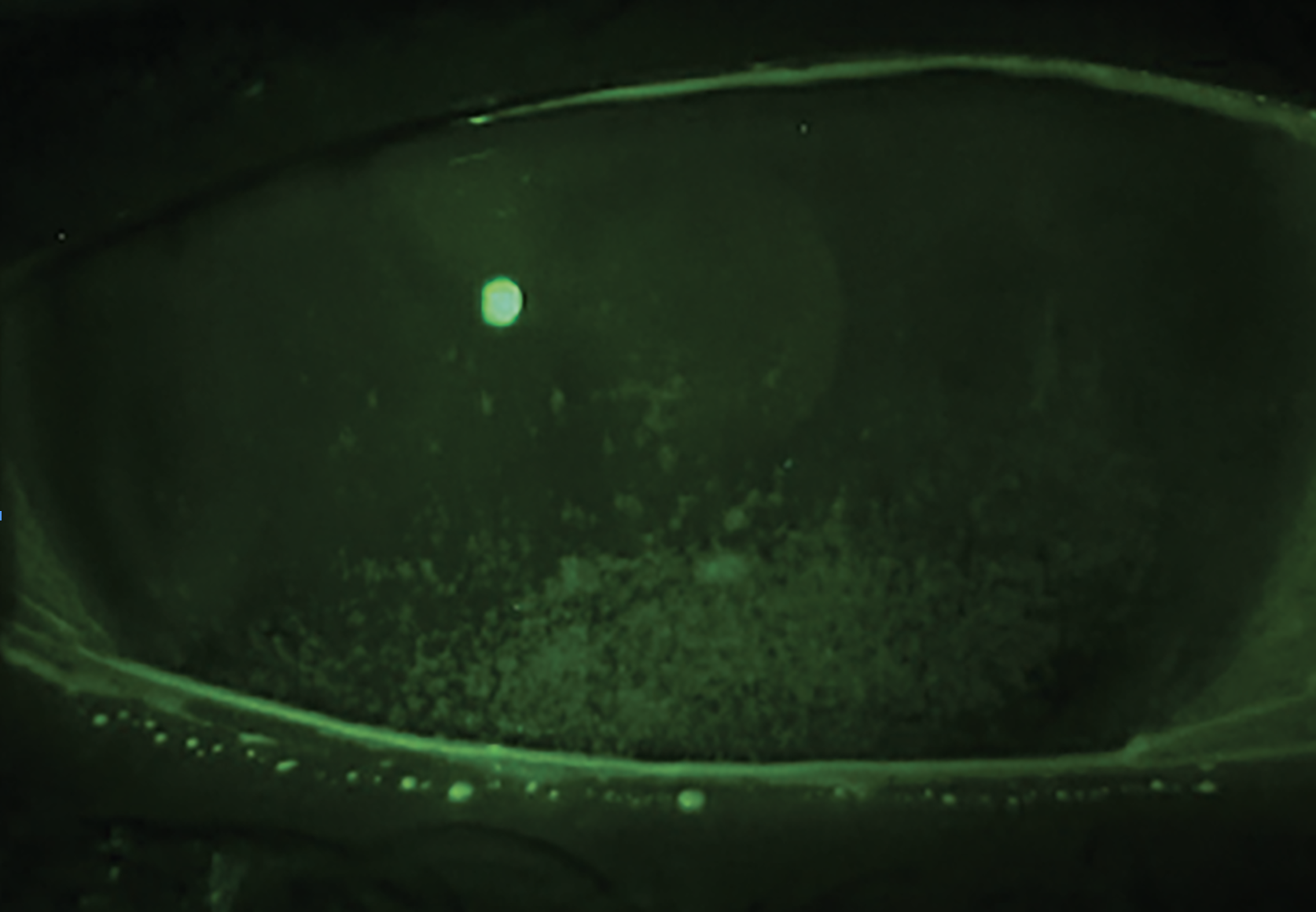 Fig. 2b. Grade 3+ coalesced corneal staining and a reduced tear meniscus in a patient with Sjögren’s syndrome. 