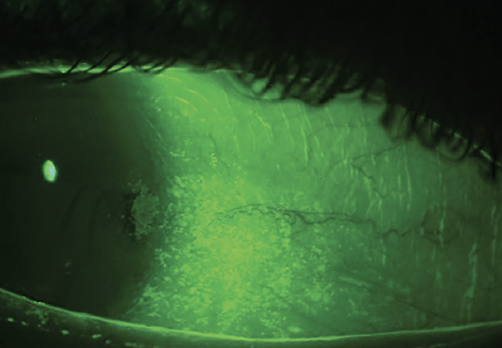 Fig. 2a. Grade 2-3+ conjunctival staining with patchy corneal staining. This is a common staining pattern seen in Sjögren’s syndrome. NaFl and a Wratten filter highlight conjunctival staining and show damage to the goblet cells and mucin layer of the tear film. Significant temporal conjunctival staining, patchy corneal staining and a reduced tear meniscus seen together warrant testing for Sjögren’s syndrome.