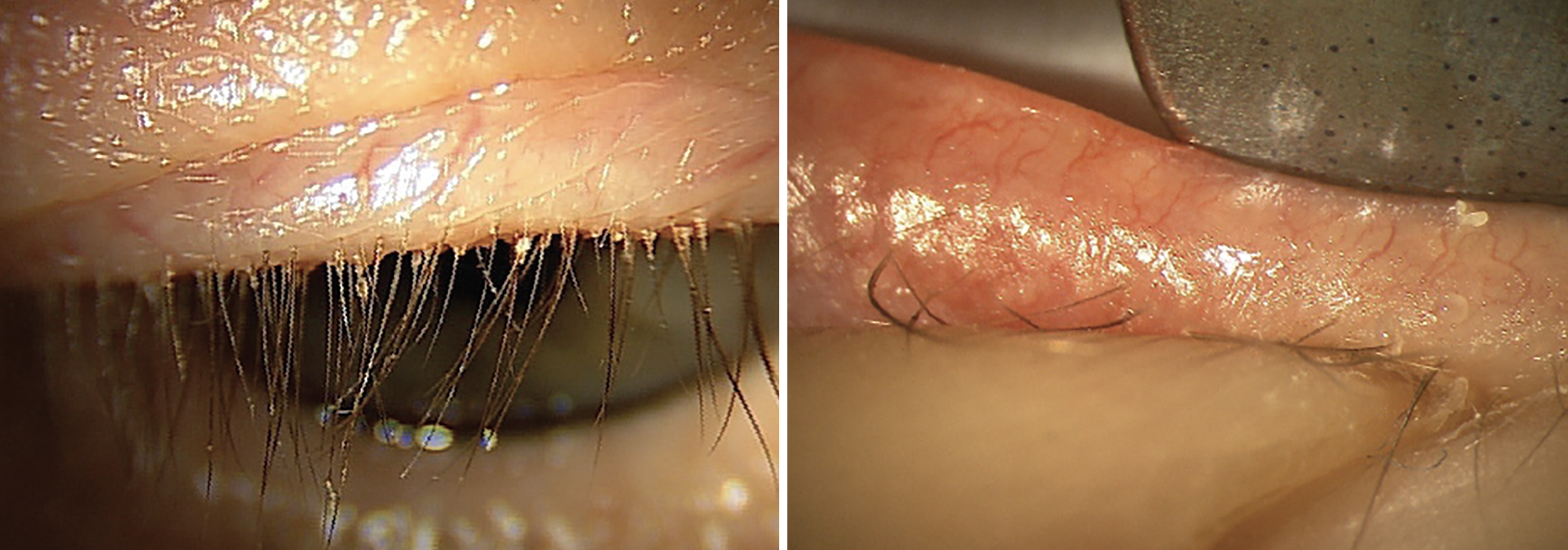 Fig. 3a. (Left) Grade 3+ collarettes at the base of a patient’s eyelashes. Collarettes are pathognomonic for Demodex blepharitis. It is important to have patients look down to examine the base of the eyelashes, as this finding is easily missed when the patient is looking straight ahead. Fig. 3b. (Right) Poor paste-like meibum expression and grade 2+ telangiectasia at the eyelid margin. Eyelid telangiectasia indicates ocular rosacea. Warm compresses would not be ideal for this type of MGD patient, as the heat exacerbates inflammation in ocular rosacea. 