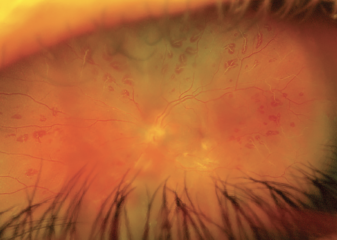Fig. 1. Fundus photo of the left eye on presentation reveals hemorrhagic vasculitis with mild diffuse vitreous haze. 