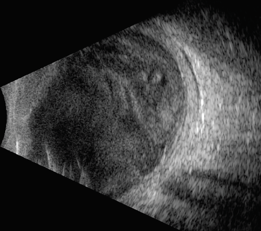 Fig. 3. Ultrasonography was performed due to severely reduced vision at follow-up. Dense vitreous opacities and early membranes are appreciable.