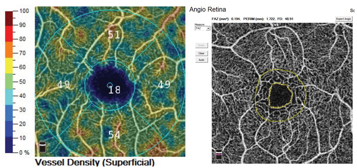 Using OCT-A, researchers captured images of the fovea and evaluated the macular vascular density and perfusion density of patients with obstructive sleep apnea syndrome, as well as those in the control group. The sleep apnea group demonstrated a significantly increased vascular density in the parafoveal and perifoveal deep capillary plexus and perfusion density in the perifoveal deep capillary plexus.
