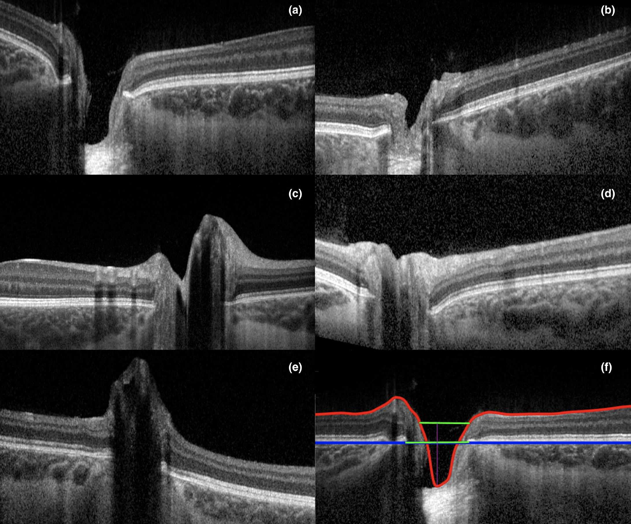 The study group saw about 30% of eyes with a ‘subnormal’ fovea and lower prevalence of foveal hypoplasia (35%) than another study. These images of study participants show a wide range of physiological feature of optic nerve hypoplasia:(a) cup below RPE, (b) cup below IRL, (c) cup above IRL, (d) no cup and  (e) peak formation. Image (f) shows demarcations of the ILM, RNFL, RPE and Bruch’s membrane opening.