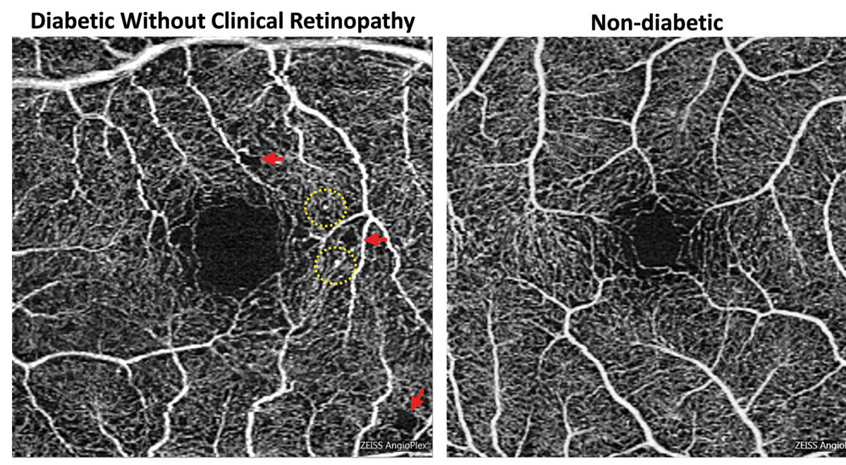 On OCT-A, decreased retinal vessel density and perfusion density was associated with a high prevalence of diabetes and elevated fasting blood glucose concentration in a recent study.
