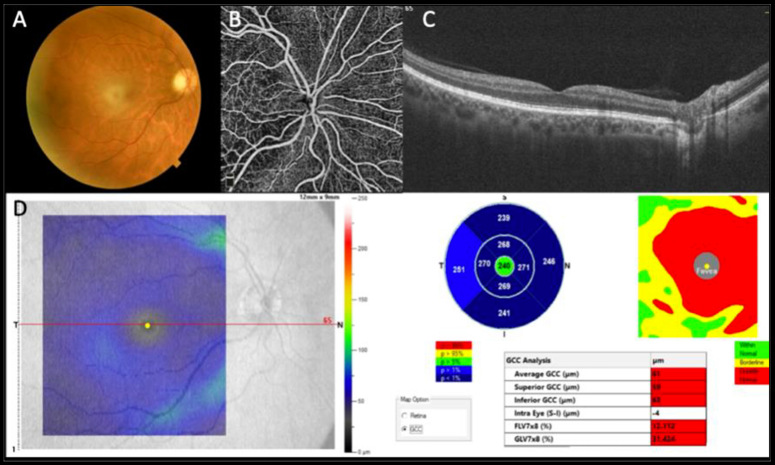 This image from the study shows a normal optic nerve in Fig. (A), wherein the posterior pole and midperiphery shows no severe morphologic changes. However, in Fig. (B) OCT-A reveals a reduction in the deep vascular pattern most evident at the posterior pole and particularly at the interpapillary-macular bundle, and the OCT B-scan in Fig. (C) reveals a reduction in the inner retinal layers where nerve fiber layers are located. In Fig. (D), we see an average reduction in the ganglion cell layer at the posterior pole compared with normative data (blue color map).